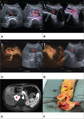 Diagnostic value of contrast-enhanced ultrasound in intravenous leiomyomatosis: a single-center experiences